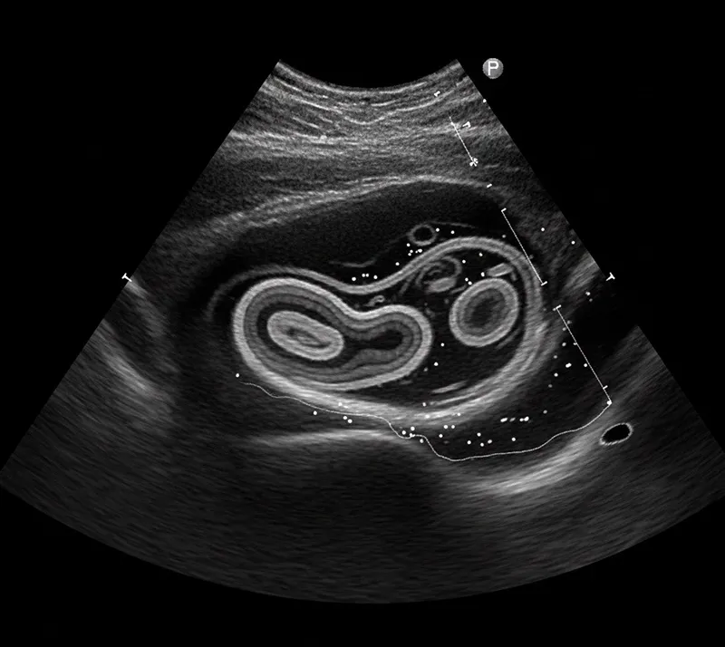 مزایای سونوگرافی روده برای افراد مبتلا به IBD