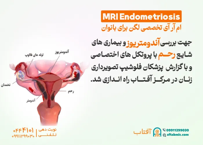 MRI ENDOMETRIOSIS ام آر آی تخصصی لگن برای بانوان در آفتاب راه اندازی شد